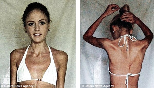 When Linn was at her skinniest she suffered panic attacks and was always cold even when wrapped up in several jumpers Read more: http://www.dailymail.co.uk/femail/article-3331787/Former-anorexic-warned-heart-stop-moment-says-weightlifting-saved-eats-build-muscle.html#ixzz3sWbeXMda  Follow us: @MailOnline on Twitter | DailyMail on Facebook